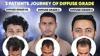 Best Hair Transplant in Cuttack (HX-GFED) | Best Results & Cost of Hair Transplant in Cuttack.