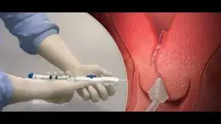 Cervical Dilator!!! Animation Video #shorts #Mbbs #knowledge