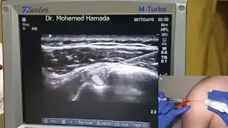 Ultrasound guided Shoulder Pain interventions