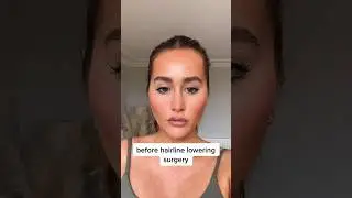 Forehead reduction/ hairline lowering surgery transformation #hairlinelowering #foreheadreduction