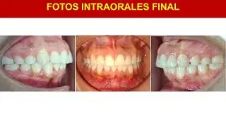 #ortodoncia  Caso clínico: Retratamiento de Clase II con apiñamiento y fusión dentaria