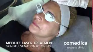 Medlite Laser Treatment Skin Rejuvenation