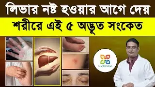 সাবধান ! ⚠️ লিভার নষ্ট হওয়ার ৫টি লক্ষণ যা( ৯৯% মানুষ জানে না)  | 5 Symptoms of Liver Disease.