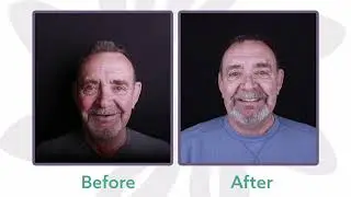 Patient Finds Confidence With Full Smile Restoration | Synergy Periodontics & Implants