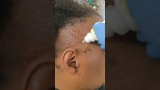 AFF EDGES BALD PATCHES Vs. inflamed scalp