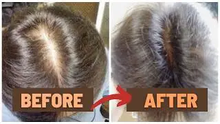 10 Years of Hair Regrowth Journey｜Minoxidil, Finasteride & Fitness Routine at 55