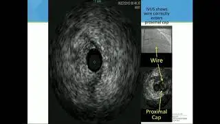 CVI 2019_Thursday 7/18_ PCI how to part 2: CTOs_M. Nicholas Burke, MD