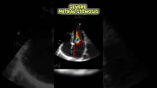 Severe Mitral Stenosis on Echocardiogram #mitralvalve #heart #echocardiography