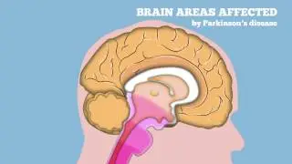 Immunotherapy for Parkinson Disease developed by EU funded project SYMPATH