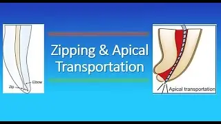 Zipping and Apical Transportation in Endodontics?