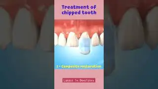 Three ways to fix a chipped tooth