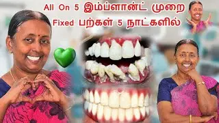 51 வயதில்  முழுவாய் Fixed பற்கள் ! Full Teeth Dental Implant At  51 Years Chennai !  #dentalclinic