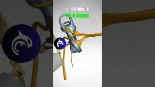 See what Hearing Loss from Nerve Damage looks like in a 4K 3D animation.