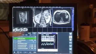 Mri kidneys