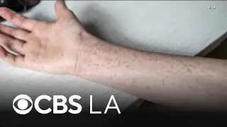 Riverside County health officials report second and third measles cases