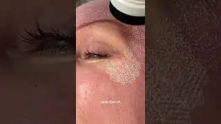 Laser Eye Lift with CO₂ laser 💫  #laser #skintightening #dermatologist