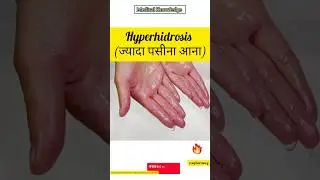 Hyperhidrosis ( ज्यादा पसीना आना) treatment medicine