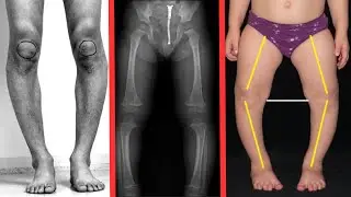 Genu varum Explained With Easy Pictures! (Bow legs)