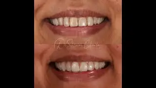 Digital Smile Design for Natural Results