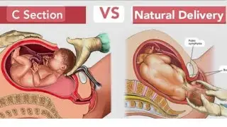 Normal Delivery vs C-Section: Pros, Cons & Recovery Time