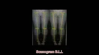 Scanogram B.Lower limb From A to Z @Radiologist_Nader