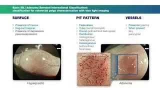 Basic Classification Colonic Polyps