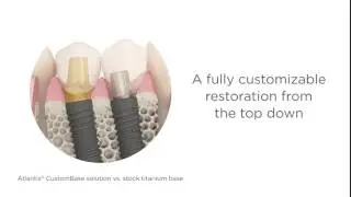 Atlantis CustomBase solution | Dentsply Sirona
