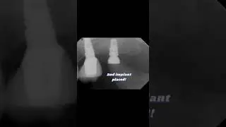 Restoring missing teeth with implants through radiographic images! #shorts #youtubeshorts #implant