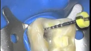 1 Root Canal Therapy sequence overview | Dentsply Sirona