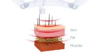 BTL Vanquish ME - Technology Made For Results