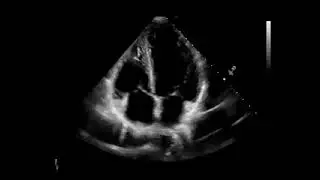 Echocardiography A4C (Apical 4 Chamber)
