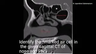 ENT image based question 60