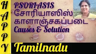 Psoriasis | சோரியாஸிஸ் | காளாஞ்சகப்படை | happy tamilnadu | explained in Tamil | Dr.Coperundevi