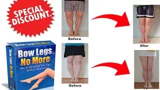 Bow Legs No More Review - How to Fix Bow Legs without Surgery