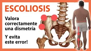 Mejora los Resultados del Tratamiento de la Escoliosis: Importancia de la Evaluación de la Dismetría