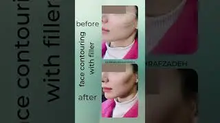 face contouring filler injection in dubai by dr.abbas ashrafzadeh #shorts #facecontouring