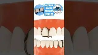 Sectional Matrix for Anterior Teeth Composite Build up