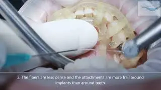 Dental Implants vs Teeth