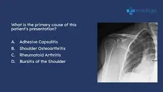 A middle aged man with diabetes presented with a frozen shoulder