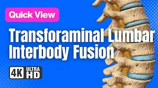 Transforaminal Lumbar Interbody Fusion (TLIF) // See How It Works // 3D Animation
