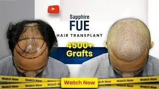 Hair Transplant Surgery Day | 4500 Grafts | Grade 4 Baldness | Hairfree & Hairgrow Bangladesh