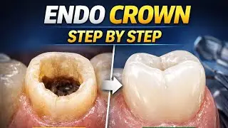 Why Endo Crowns Are Better Than Traditional Crowns