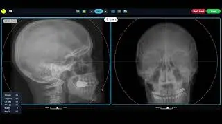 What is 3Dof and 6Dof in Radiotherapy? | Degrees of Freedom