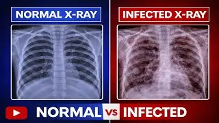 TB in X-ray /Normal lung vs Infected lungs 🫁 #lungs#chest #radiology #xray#radiology#medicos#doctor