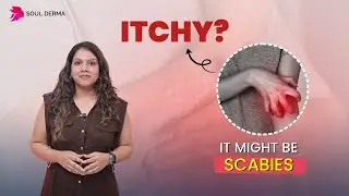Scabies Explained: Causes, Symptoms & Treatment by Dermatologist
