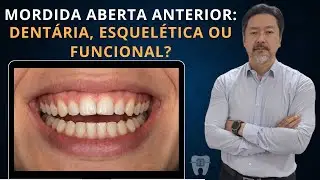 Tipos de Tratamento para Mordida Aberta Anterior #09