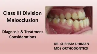 &ldquo;Dental notes#Class III Malocclusion (Underbite): Causes, Types & Treatment Options