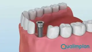 Procedimento de Implante Dent&aacute;rio - Demonstra&ccedil;&atilde;o 3D