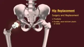 HipReplacement.mov