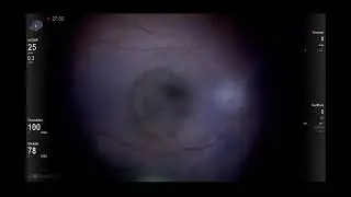The Simultaneous contrast concept ,behind Alcon Ngenuity 3D digital filtering Lukan Mishev